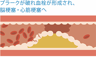 プラークが破れ血栓が形成され、脳梗塞・心筋梗塞へ