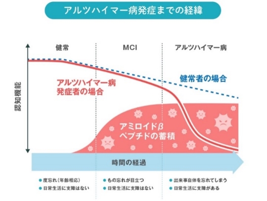 アルツハイマー病発症までの経緯